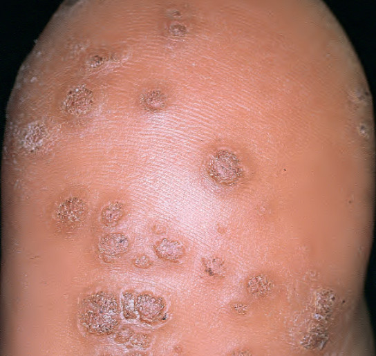 plantar warts