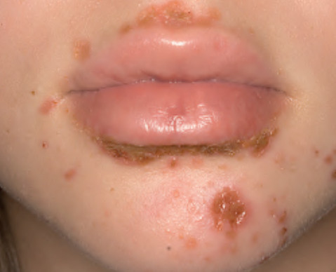 impetigo