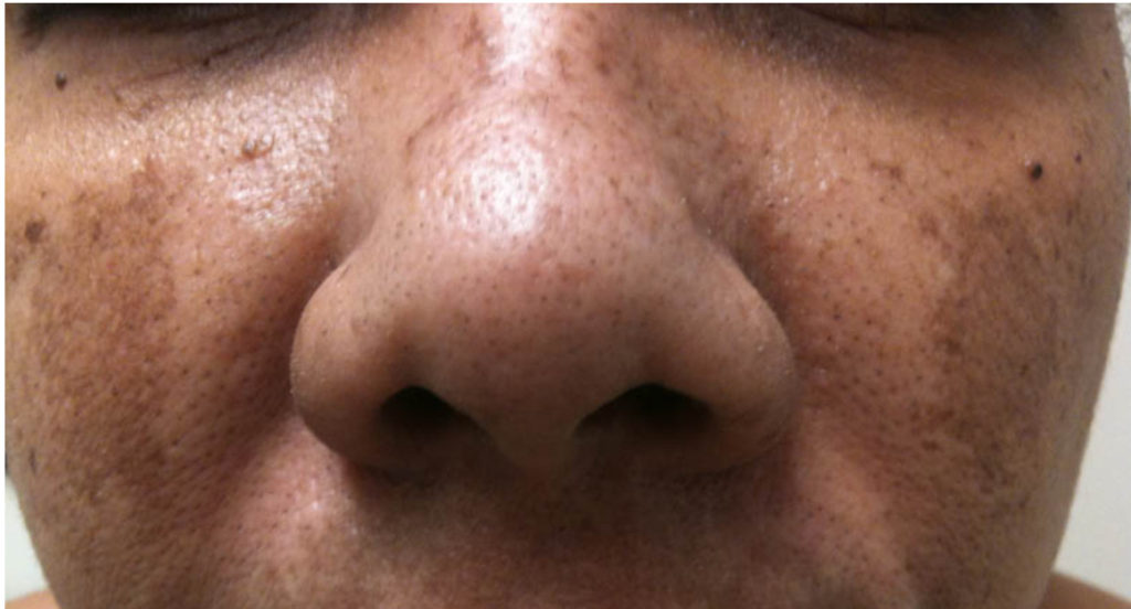 Melasma