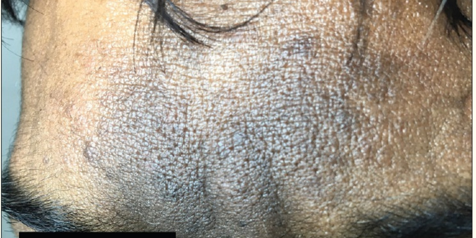 Facial acanthosis.
