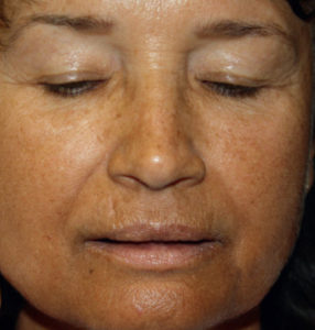 hyperpigmentation acquired facial addison