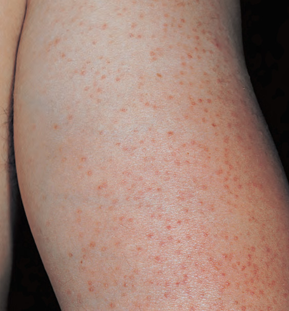 keratosis pilaris.