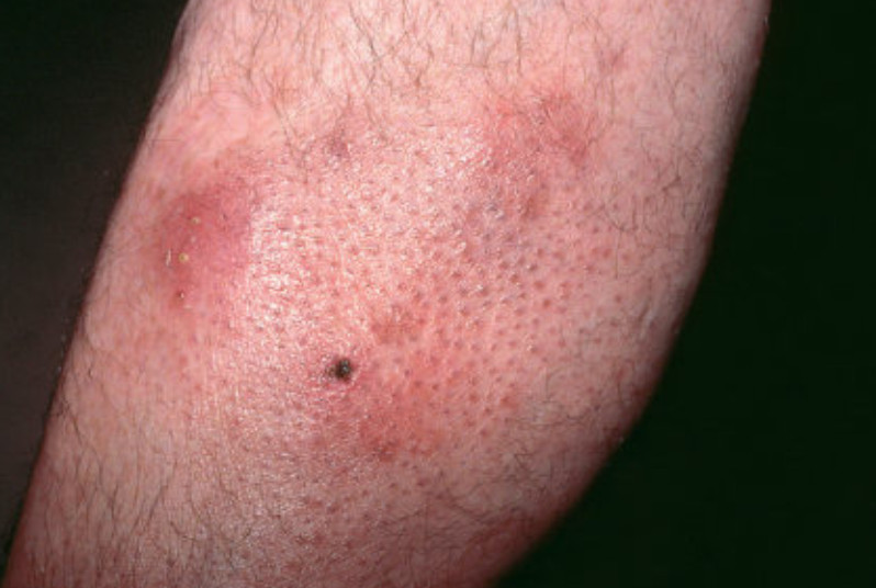 Follicular mucinosis.