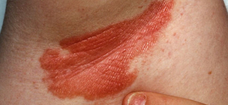 Inverse psoriasis