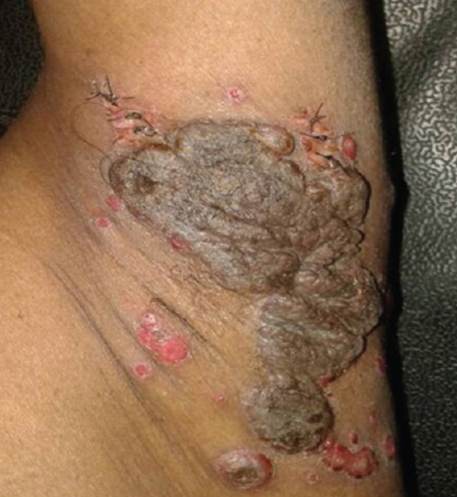 Pemphigus vegetans