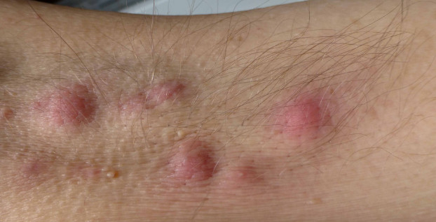 Hidradenitis suppurativa