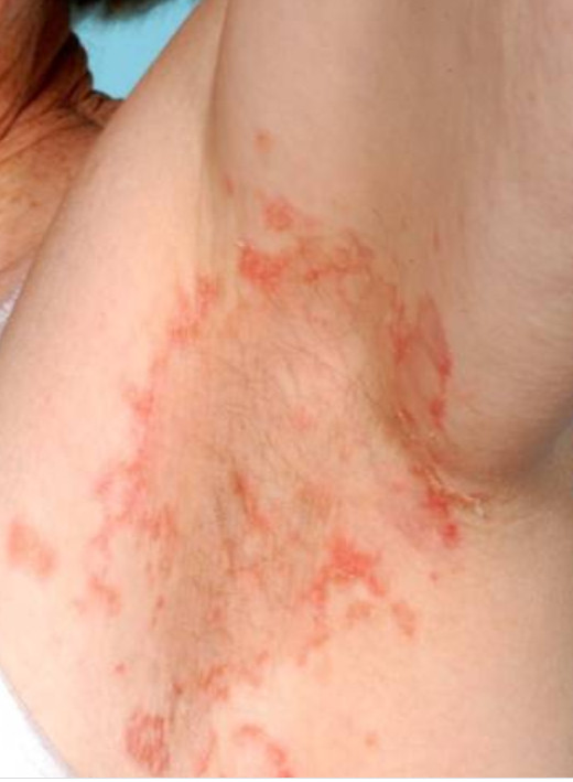 Necrolytic migratory erythema