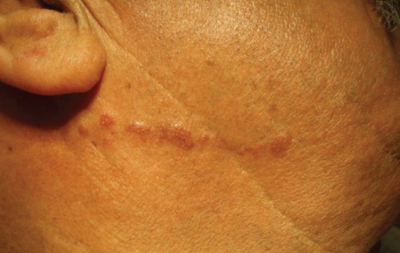 Linear cutaneous lupus erythematosus