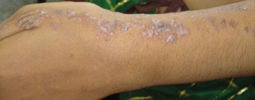 Linear Lichen planus