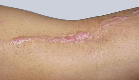  inflammatory linear verrucous epidermal naevus (ILVEN)