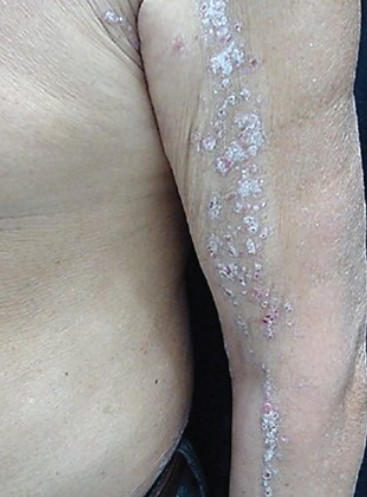 Linear psoriasis