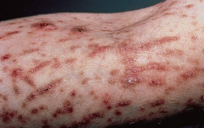 Keratosis lichenoides chronica