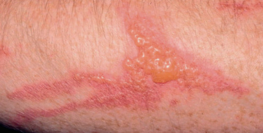 Allergic contact dermatitis