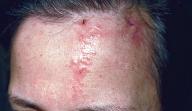 Linear lesions in dermatology | Dermatology Games