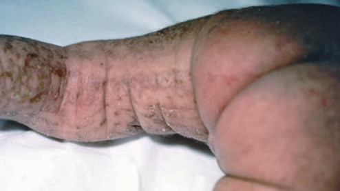 Incontinentia pigmenti.