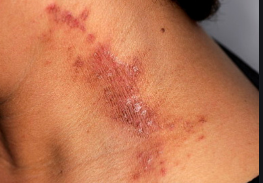 Paederus dermatitis