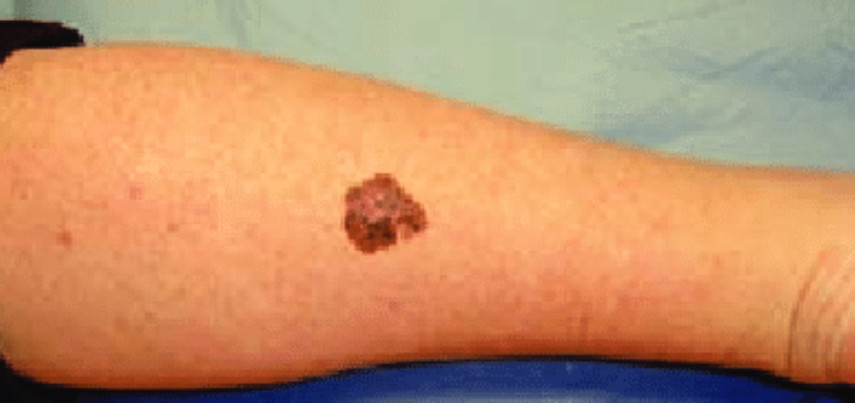 Melanoma