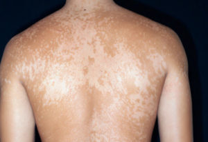 Tinea versicolor treatment options options | Dermatology Games