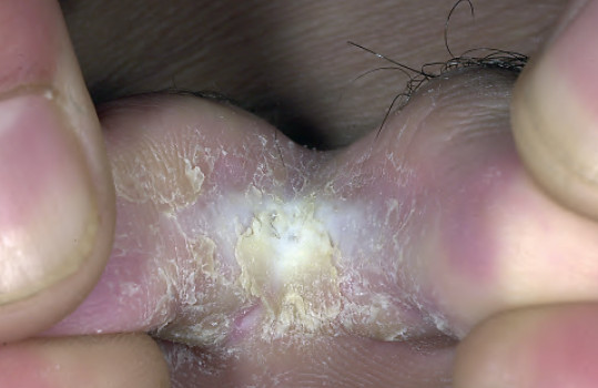 Tinea pedis