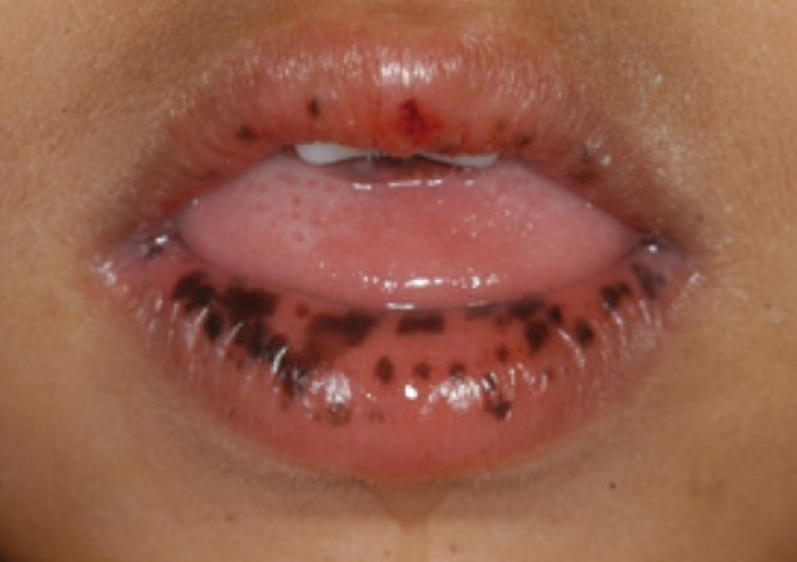 Hyperpigmented lip lesions differntial diagnosis | Dermatology Games