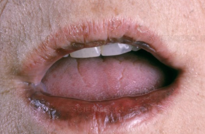 Addison's Disease: lip pigmentation