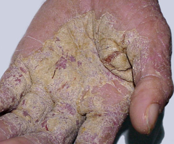 Crusted scabies