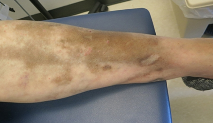 Hydroxychloroquine induced pigmentation in Lupus pt.