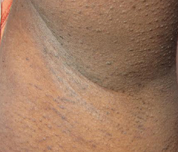 Nonscarring alopecia over the axilla in Graham–Little–Piccardi syndrome 