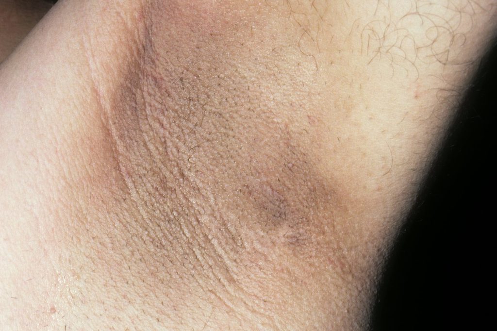 Acanthosis nigricans