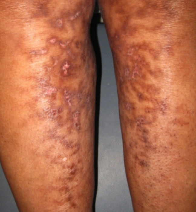 Erythema ab igne