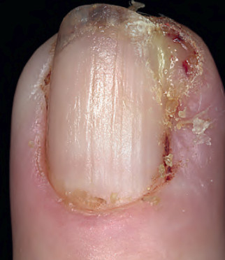 Ingrown nail