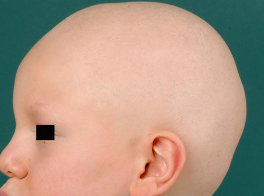 Alopecia areata
totalis