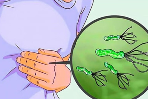 H pylori