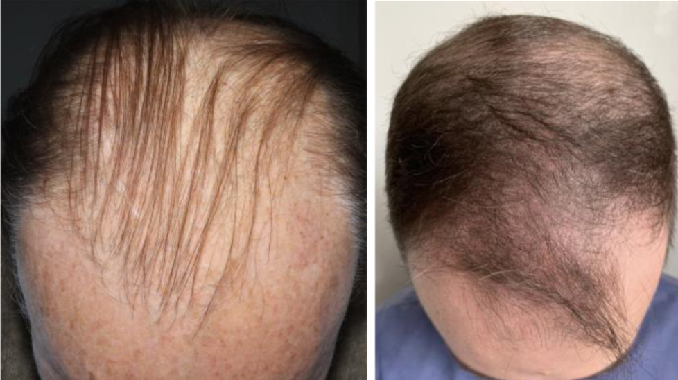 Androgenetic alopecia (Gabrin sign)