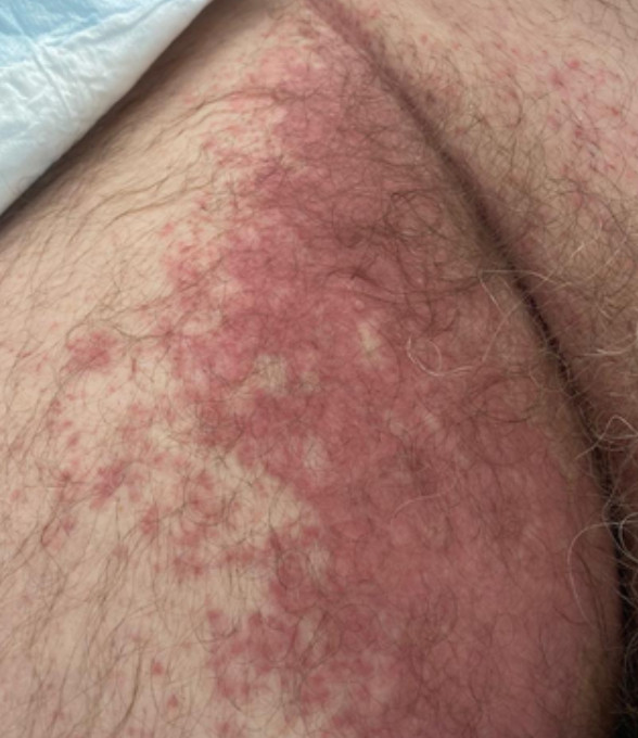 Bilateral inguinal purple rash