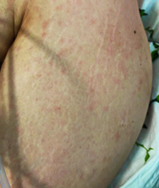 Measles‐like maculopapular rash