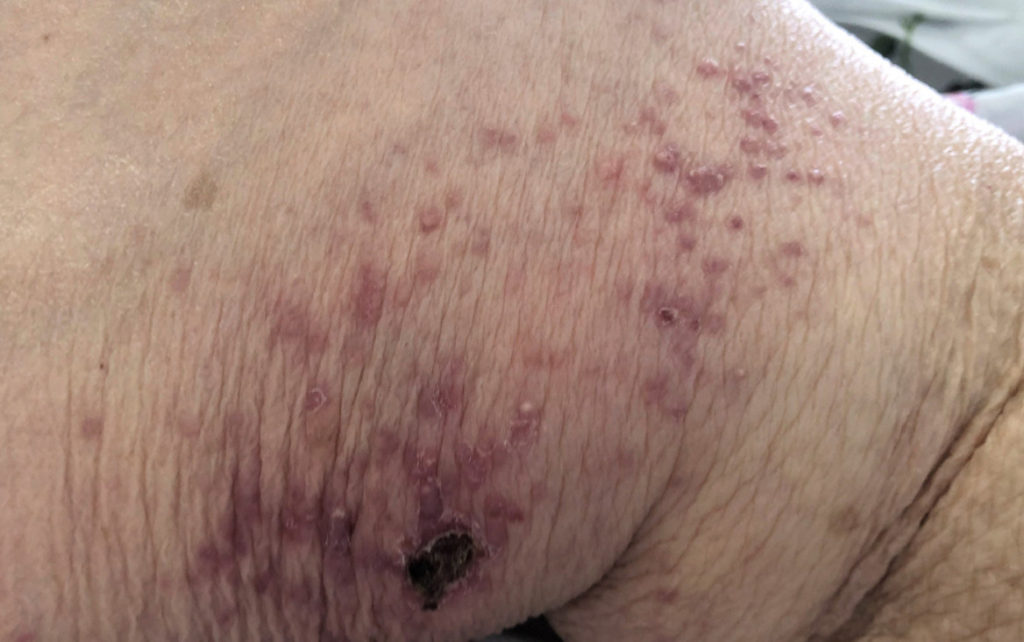 Papulonecrotic skin vasculitis