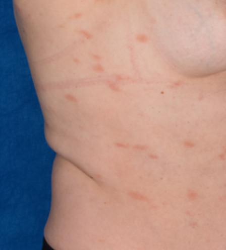 Pityriasis rosea‐like lesions