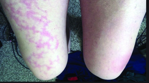 Unilateral livedoid rash