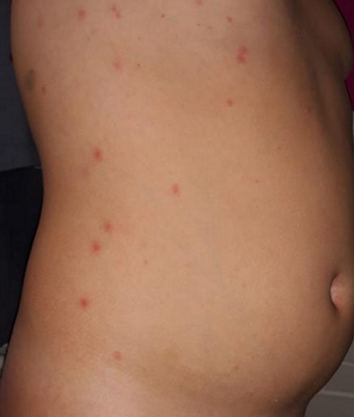 Varicella‐like exanthem