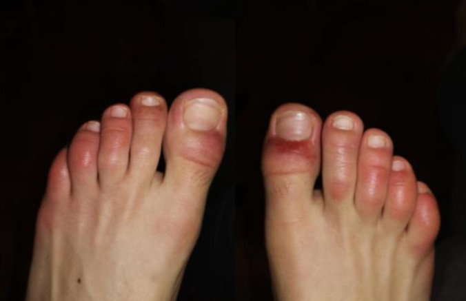 pseudo‐chilblains