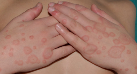 erythema multiforme like lesions