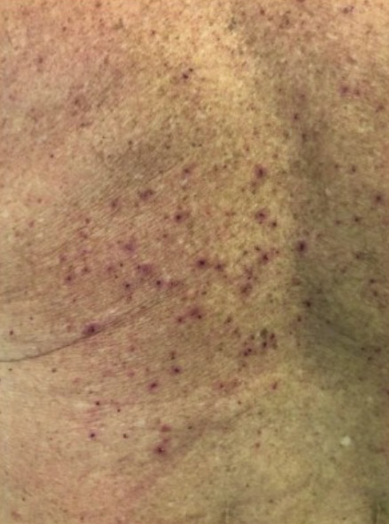 maculo-papular itchy rash like grover disease