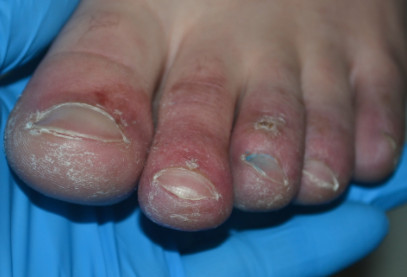 pseudo‐chilblains