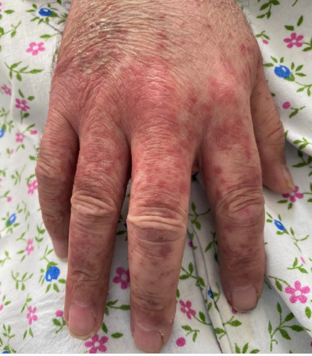 vasculitis 