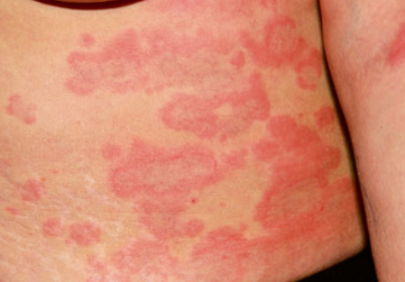 urticaria approach