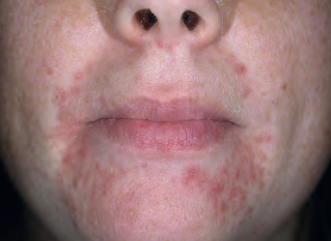 Perioral dermatitis